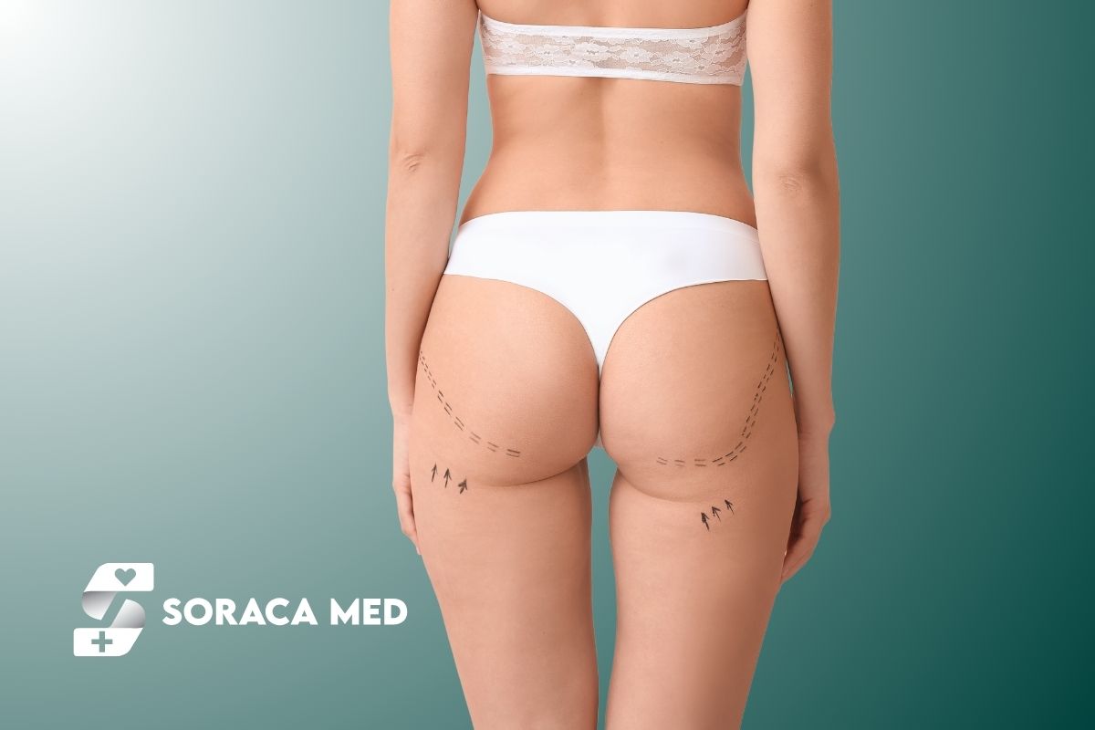 What Is Buttock Fillers