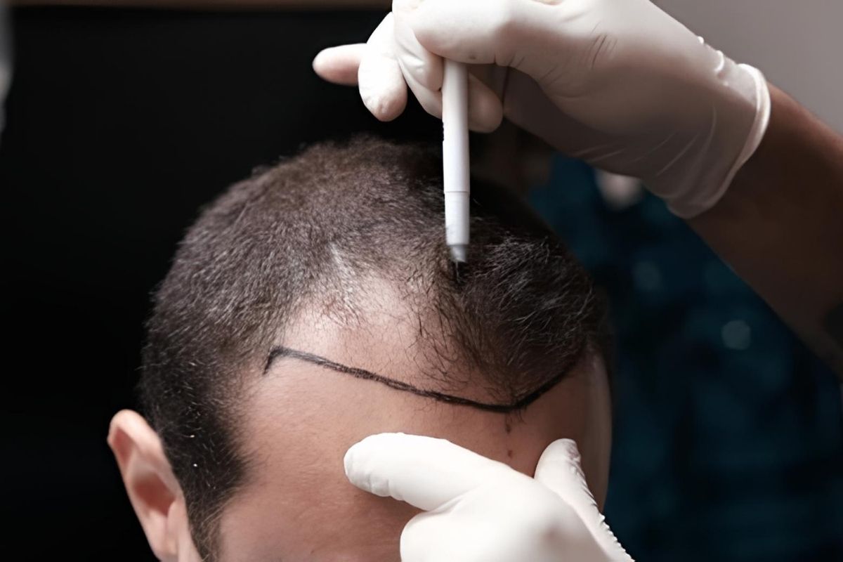 Pain After Hair Transplant