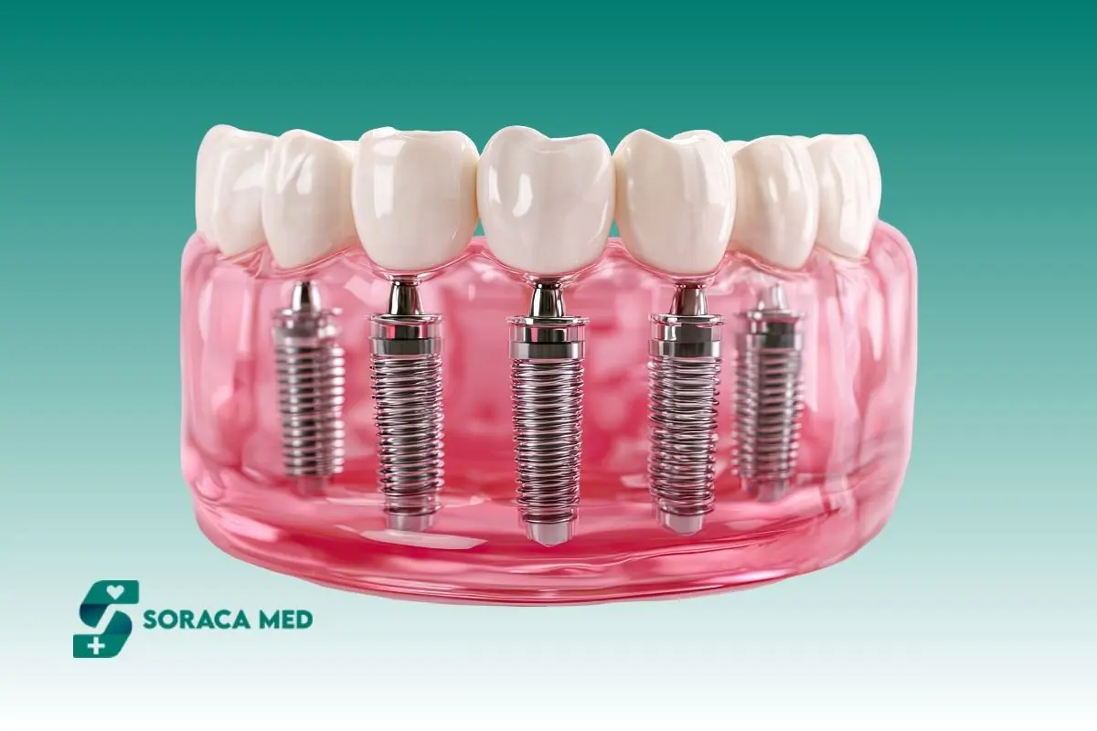 Co To Jest Implant Zębowy? Rodzaje, Zabieg I Efekty