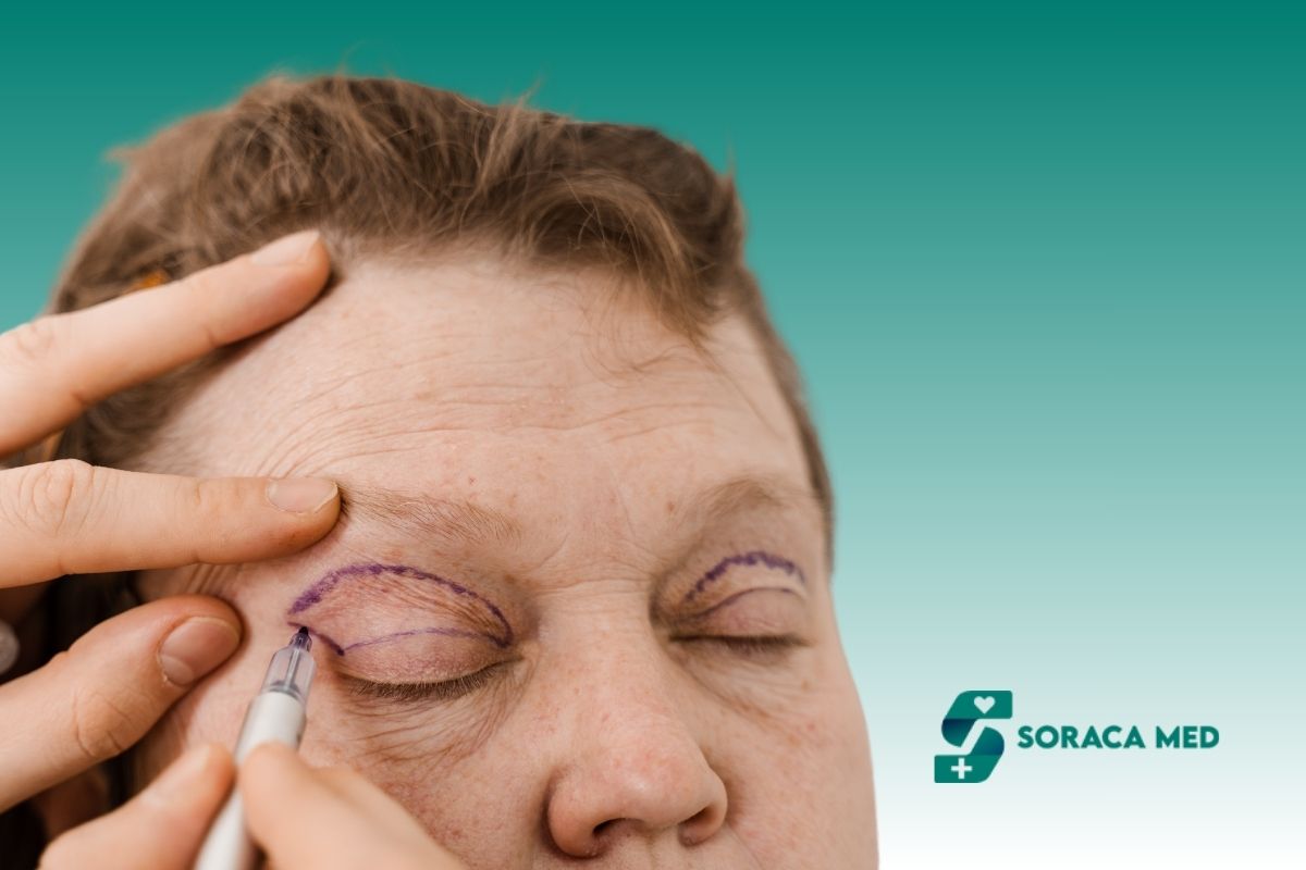 Upper Eyelid Surgery Cost
