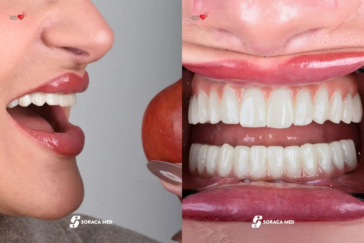 Dantų implantai Turkijoje