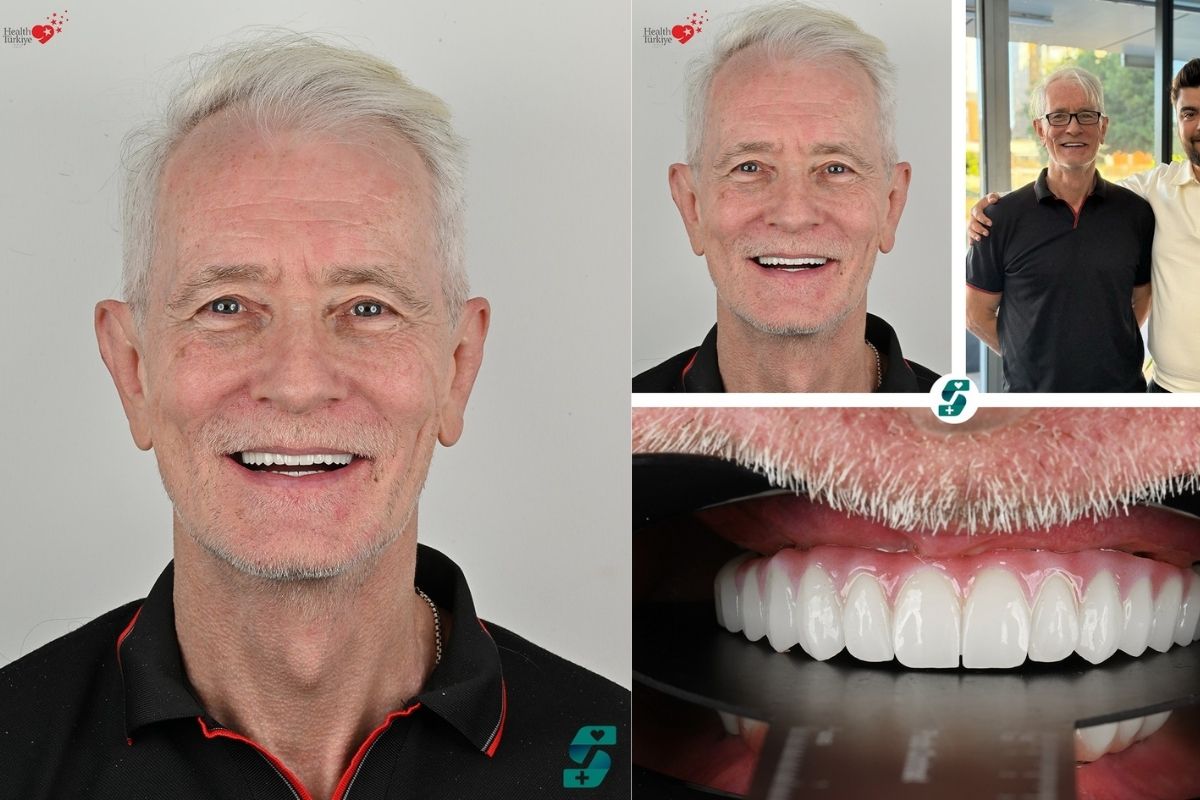 Dental Crown Cost In Uk