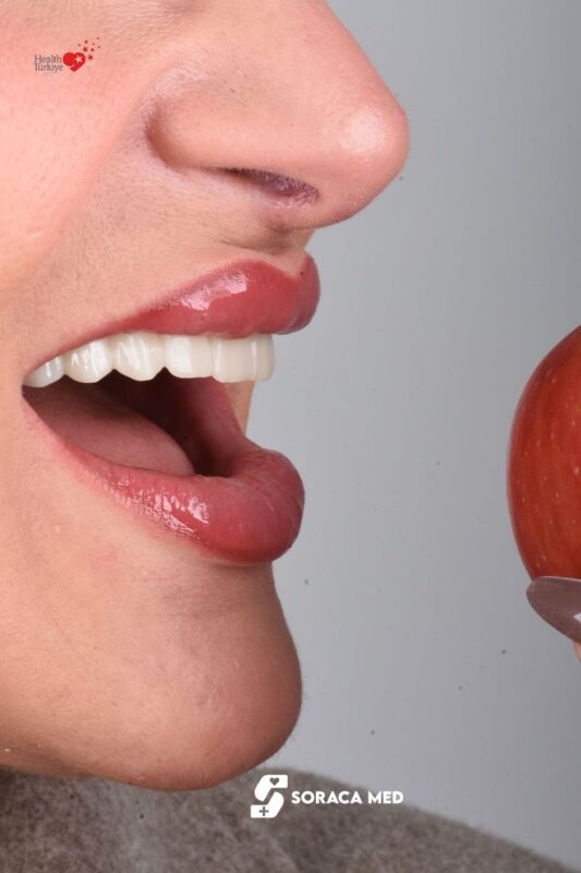 All On Four Dental Implants: Cost, Comfort, Recovery &Amp; Real Patient Questions