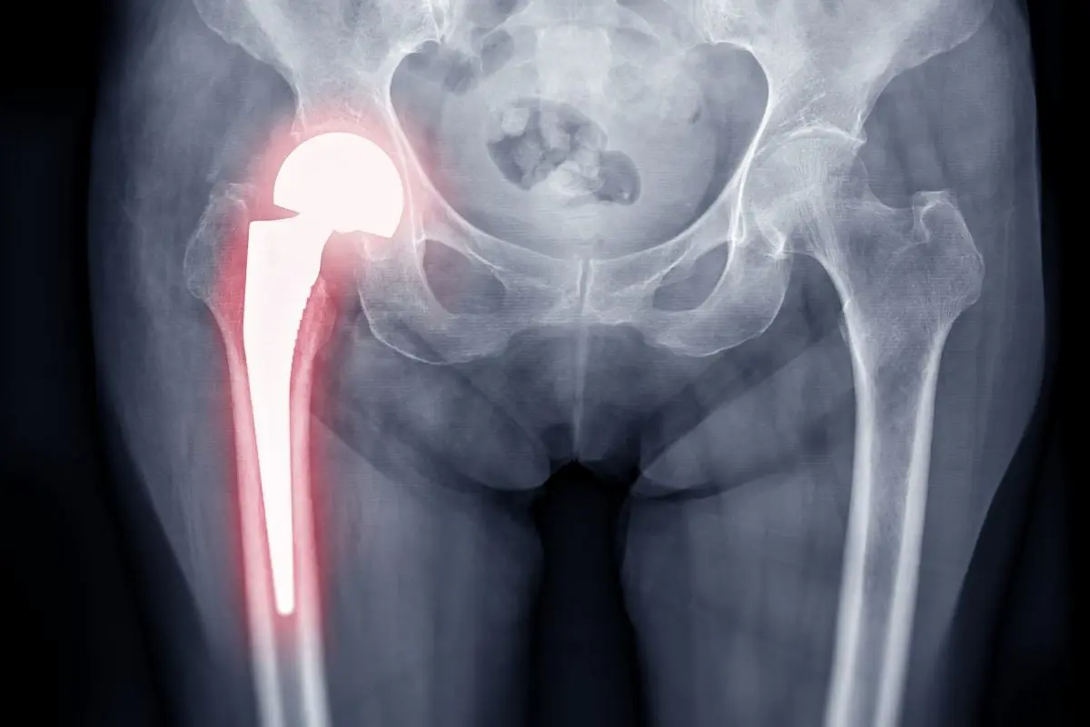 Hip Replacement In Turkey: Cost, Procedure And Recovery Guide