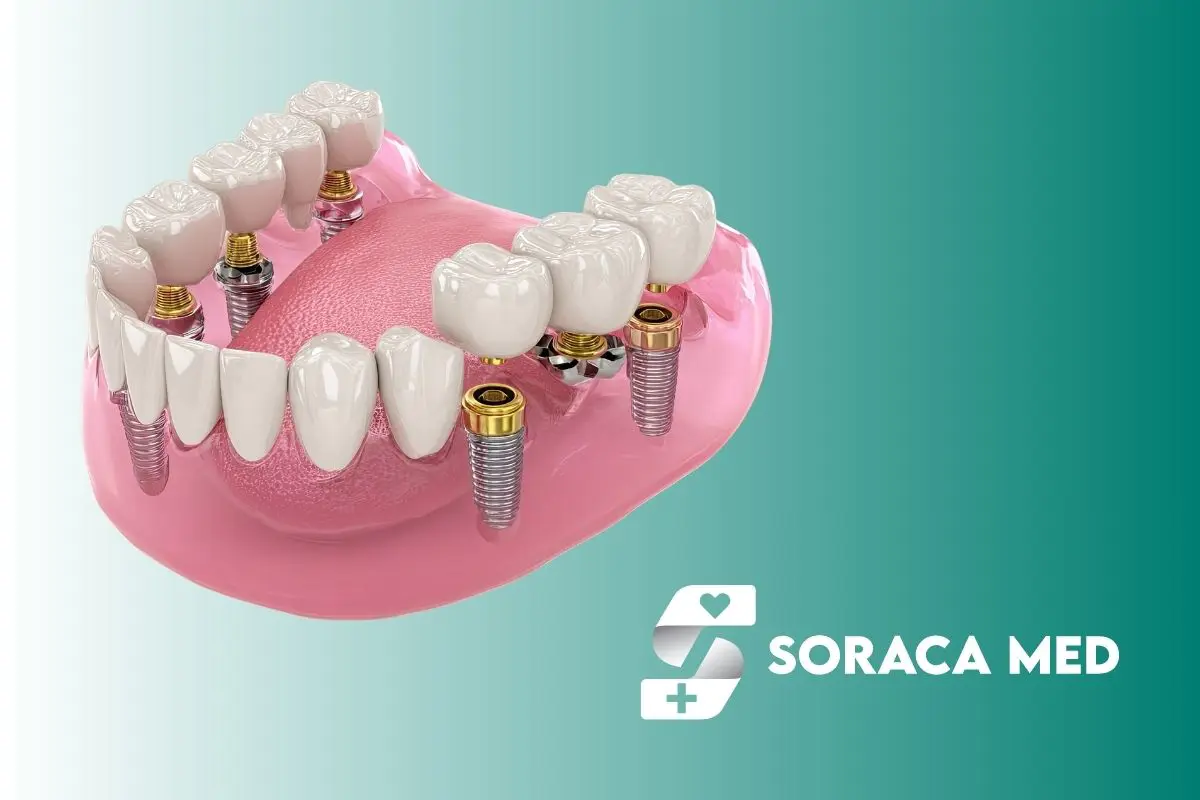 Implanturi zigomatice în Antalya – soluția pentru lipsa osului maxilar 2 Cât Costă Implanturile Zigomatice În Antalya