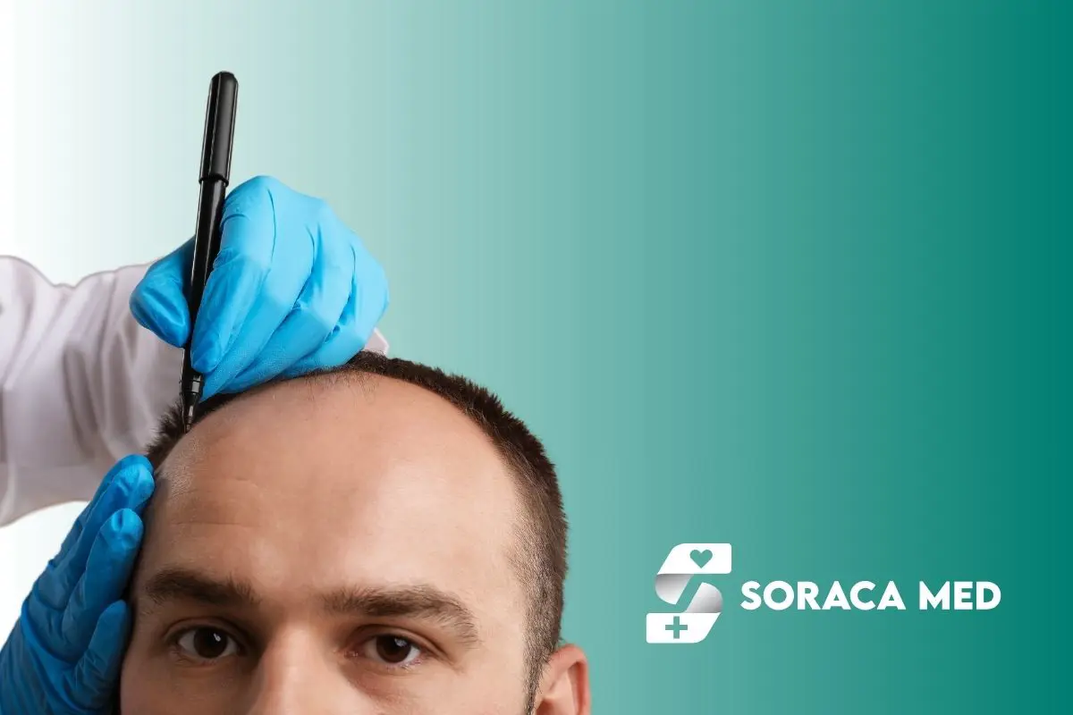 Kosten für eine Haartransplantation in Antalya