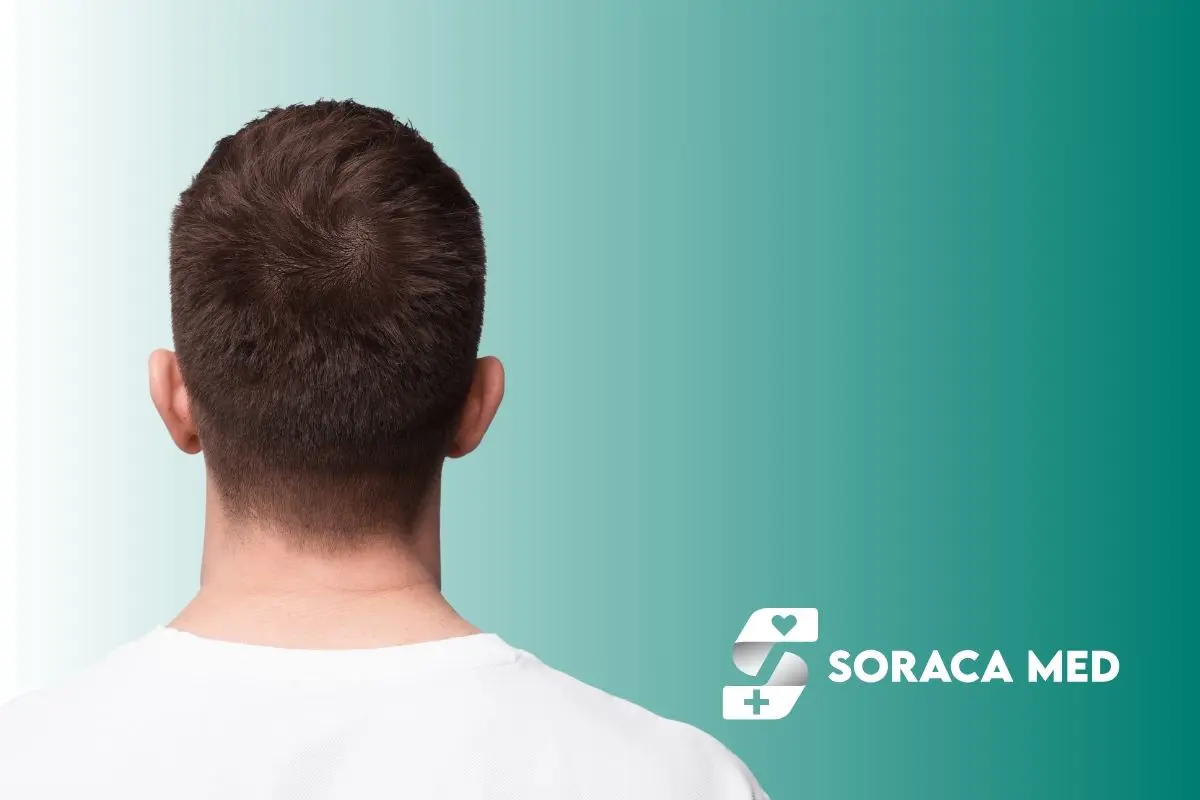 Kosten Für Haartransplantation In Großbritannien Im Vergleich Zur Türkei