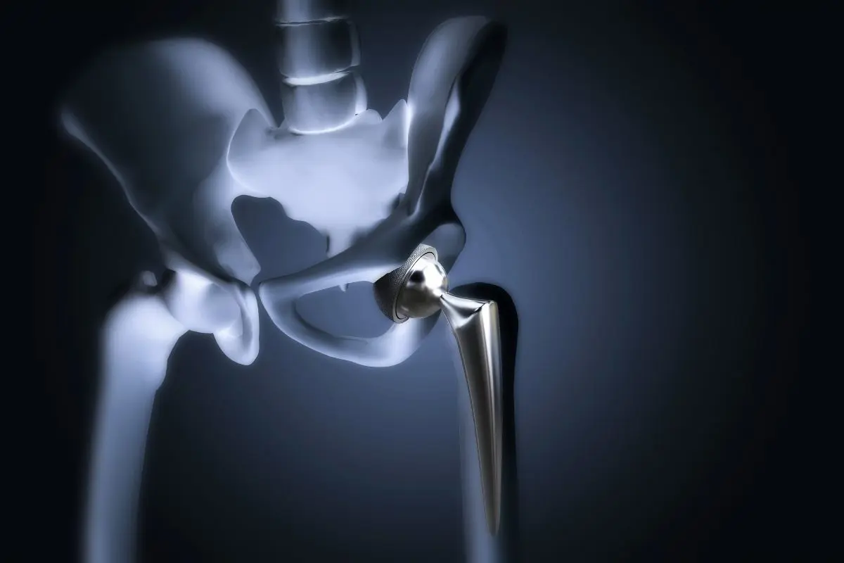 Hip Replacement In Turkey: Cost, Procedure And Recovery Guide