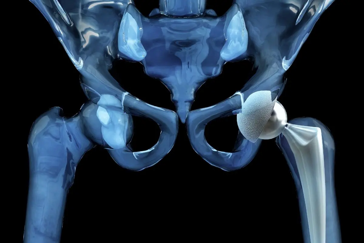 Hip Replacement Surgery