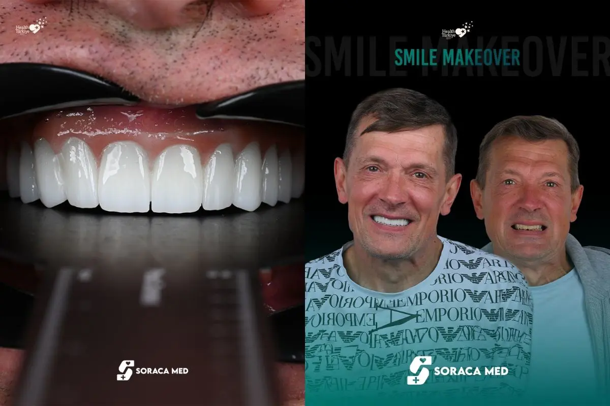 Implanty zębów w Turcji cena