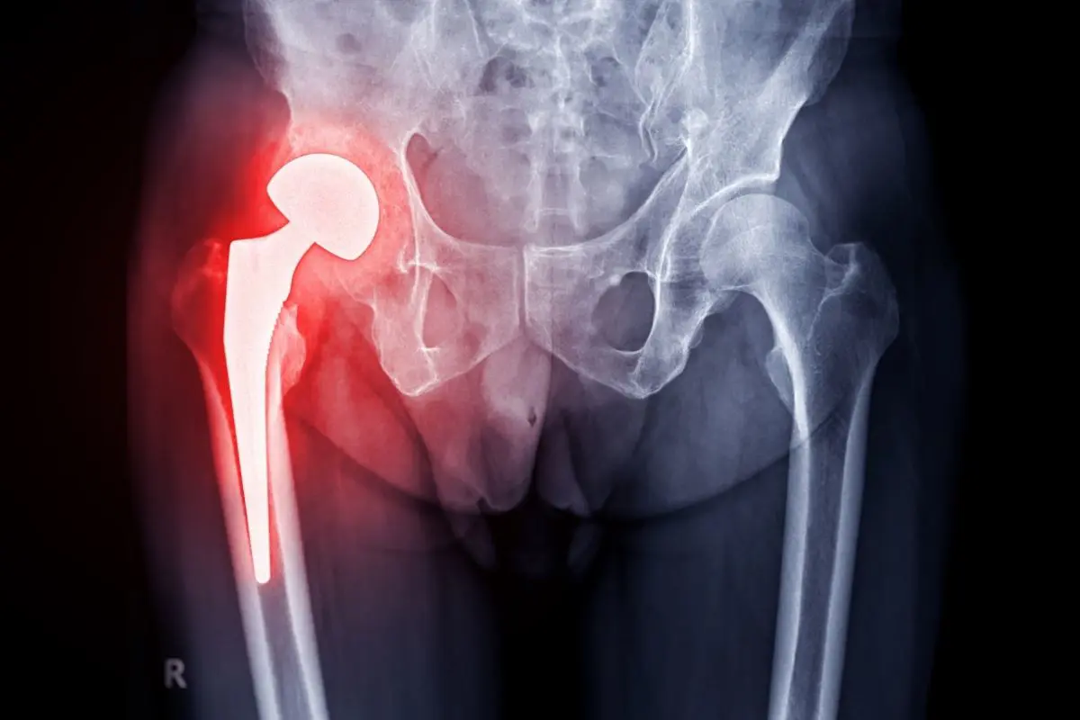 Hip Replacement in Turkey