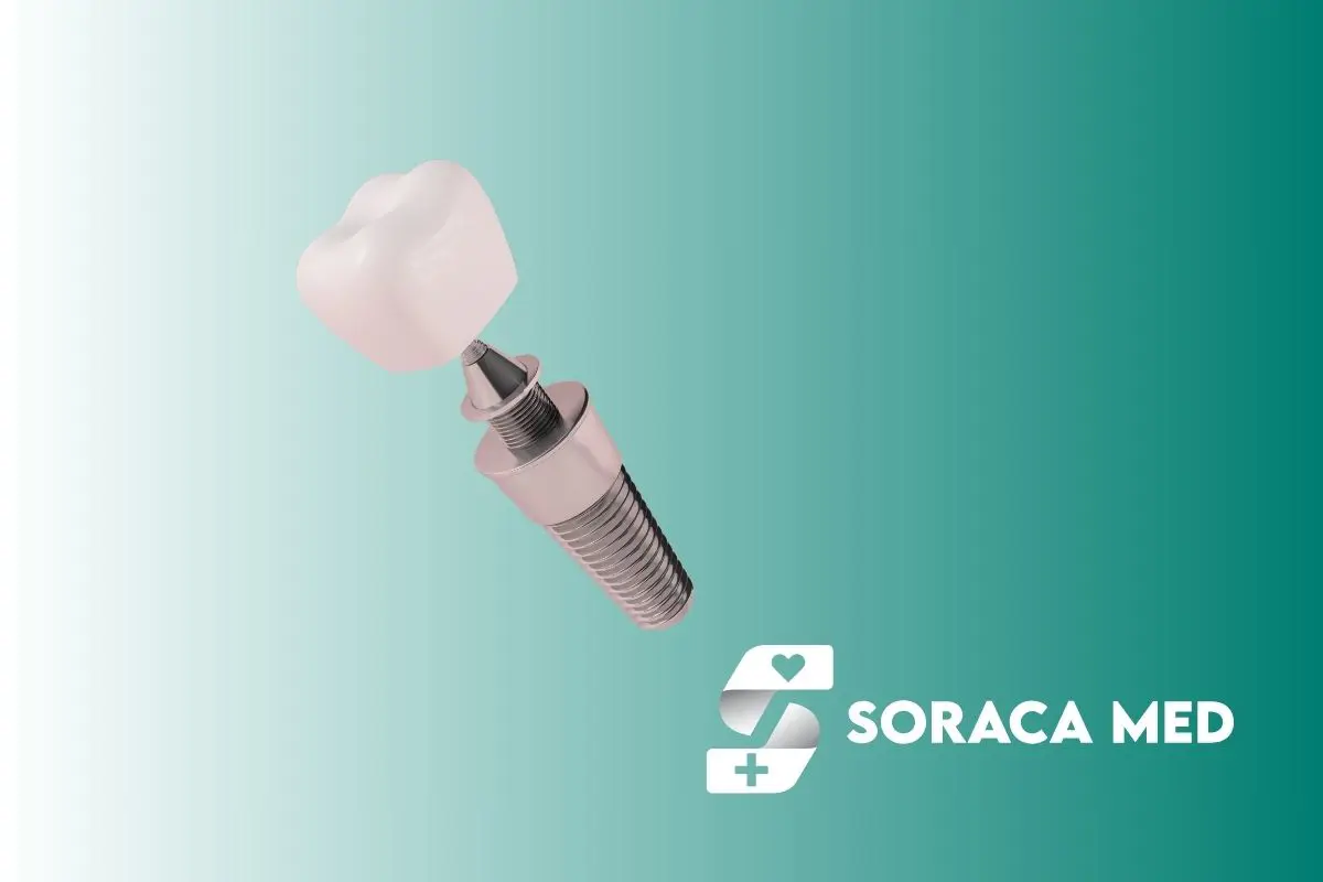 Implanturi zigomatice în Antalya – soluția pentru lipsa osului maxilar 1 Implanturile Zigomatice