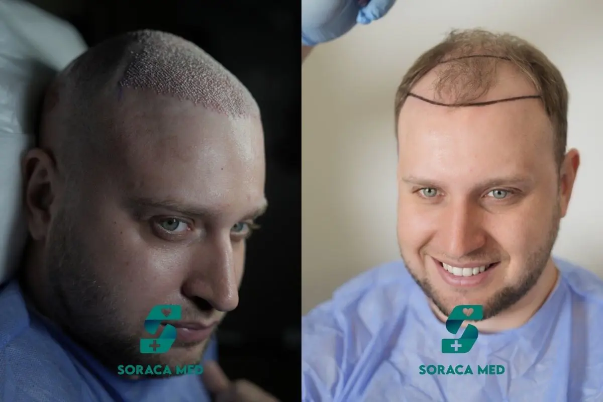 Haartransplantation Kosten