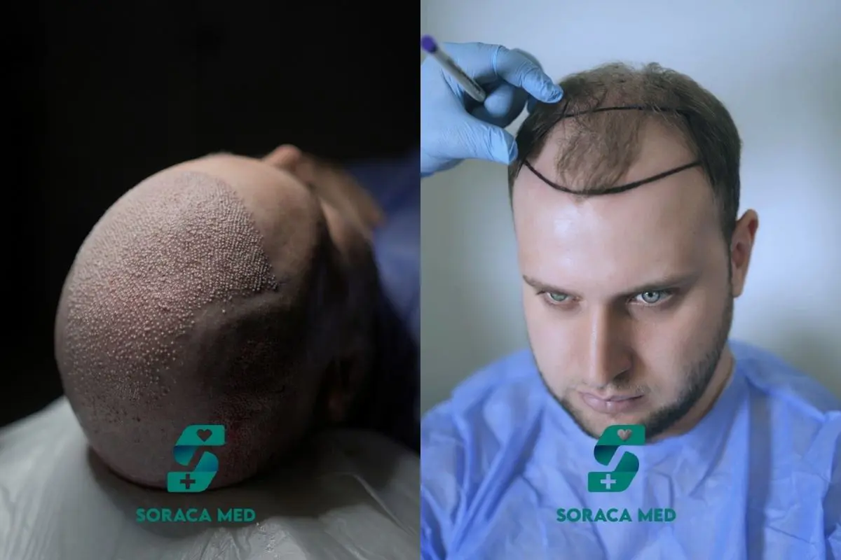 Haartransplantation  Soraca Med