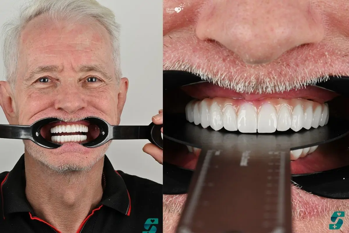 Jak Wygląda Rekonwalescencja Po All-On-4