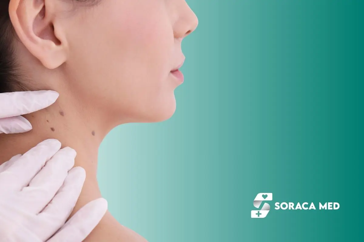 Mole Removal in Antalya