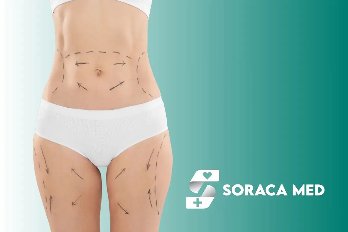 Recuperación De La Abdominoplastia