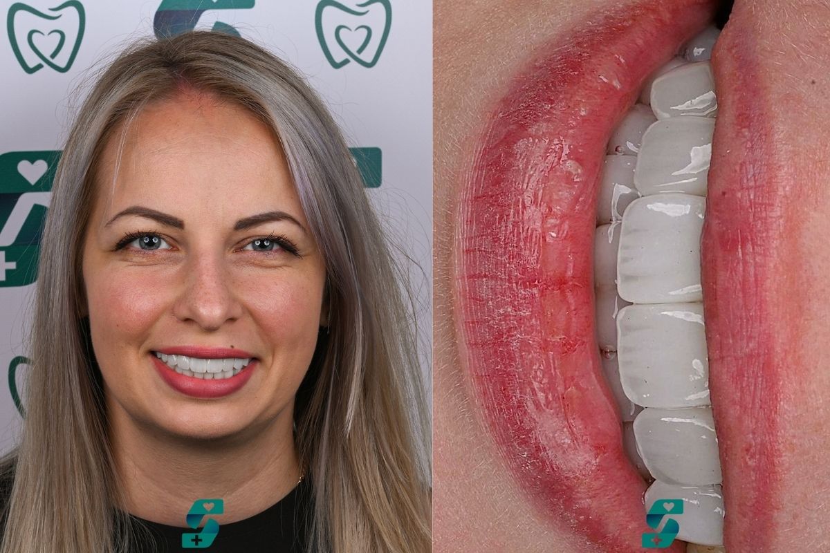 Veneers Berlin Kosten