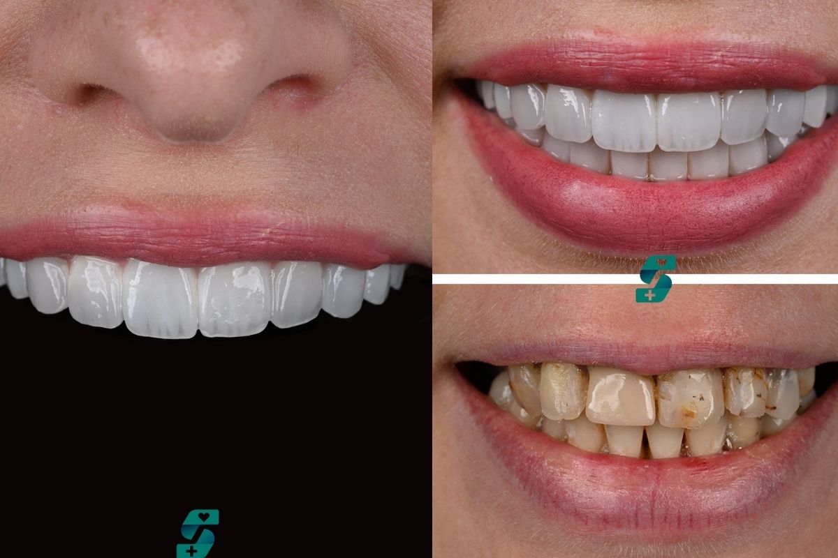 Wie Lange Halten Veneers