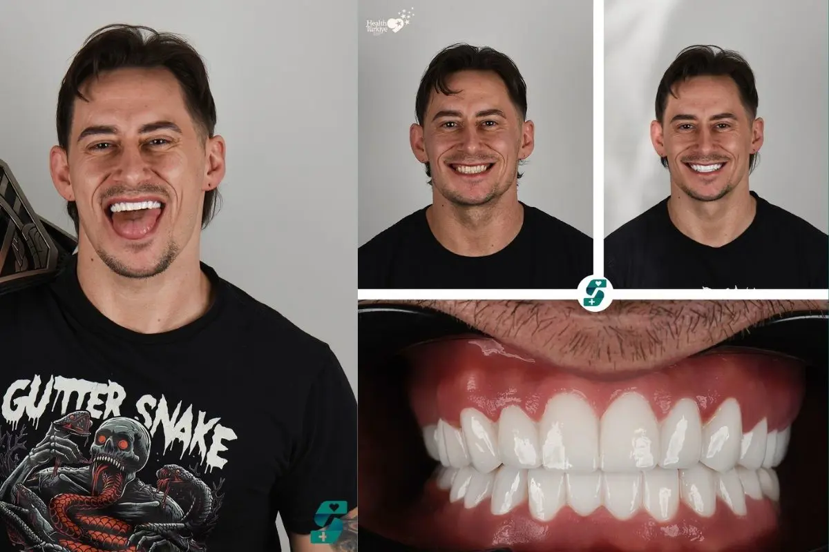 Zahnimplantat Kosten Preise