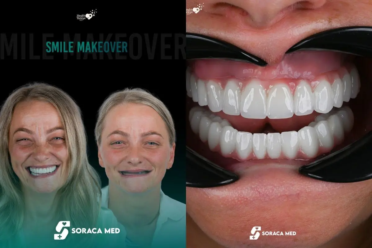 Smile-Makeover-Patient-Results-2