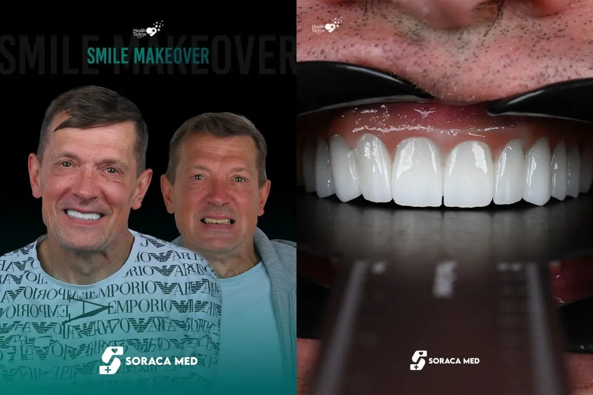 Smile-Makeover-Patient-Results