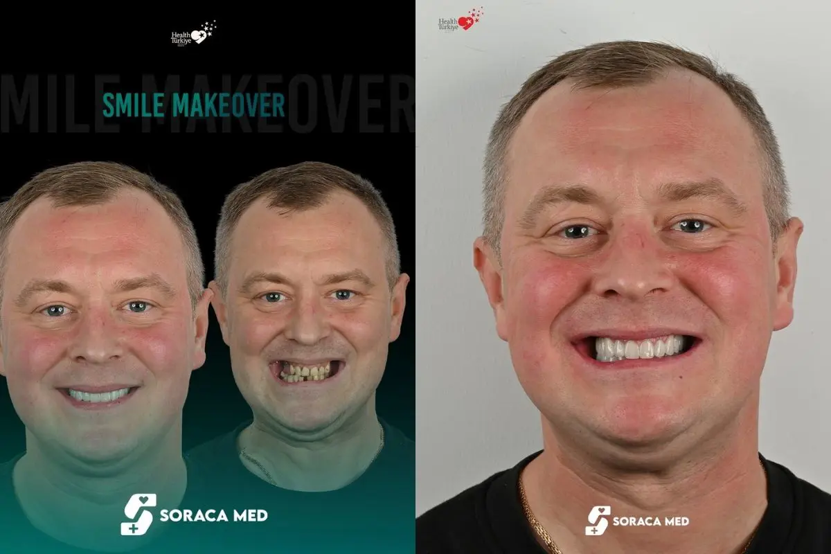 Smile-Makeover-Patient-Resuluts-3