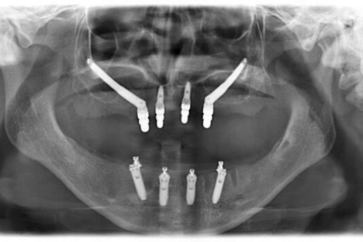 Zygomatic Implants Cost in Turkey X-Ray