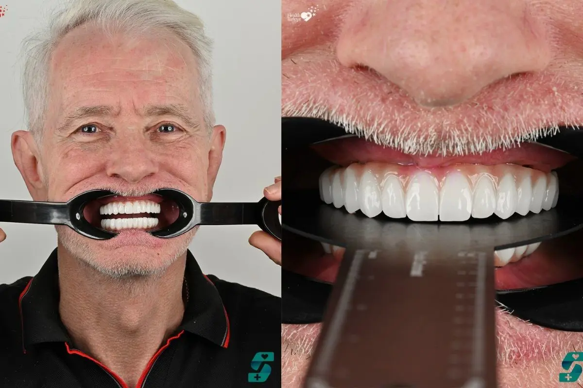Dental Implants Cost in Antalya: A Complete Price Guide for Patients 1 Dental Implants Cost In Antalya Vs Uk