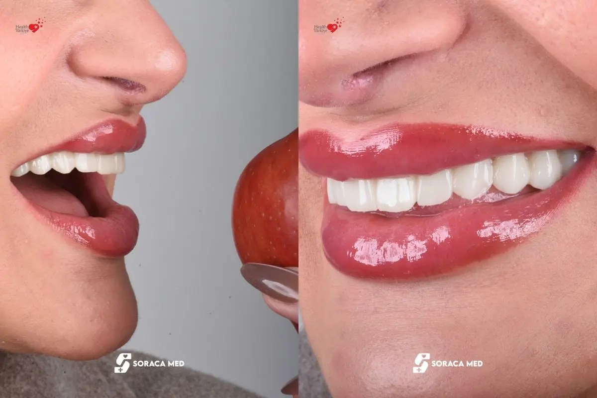 Dental Implants Cost in Antalya