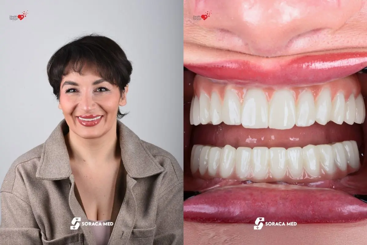 Dental Implants Cost in Antalya: A Complete Price Guide for Patients 2 Full Mouth Dental Implants Cost In Antalya