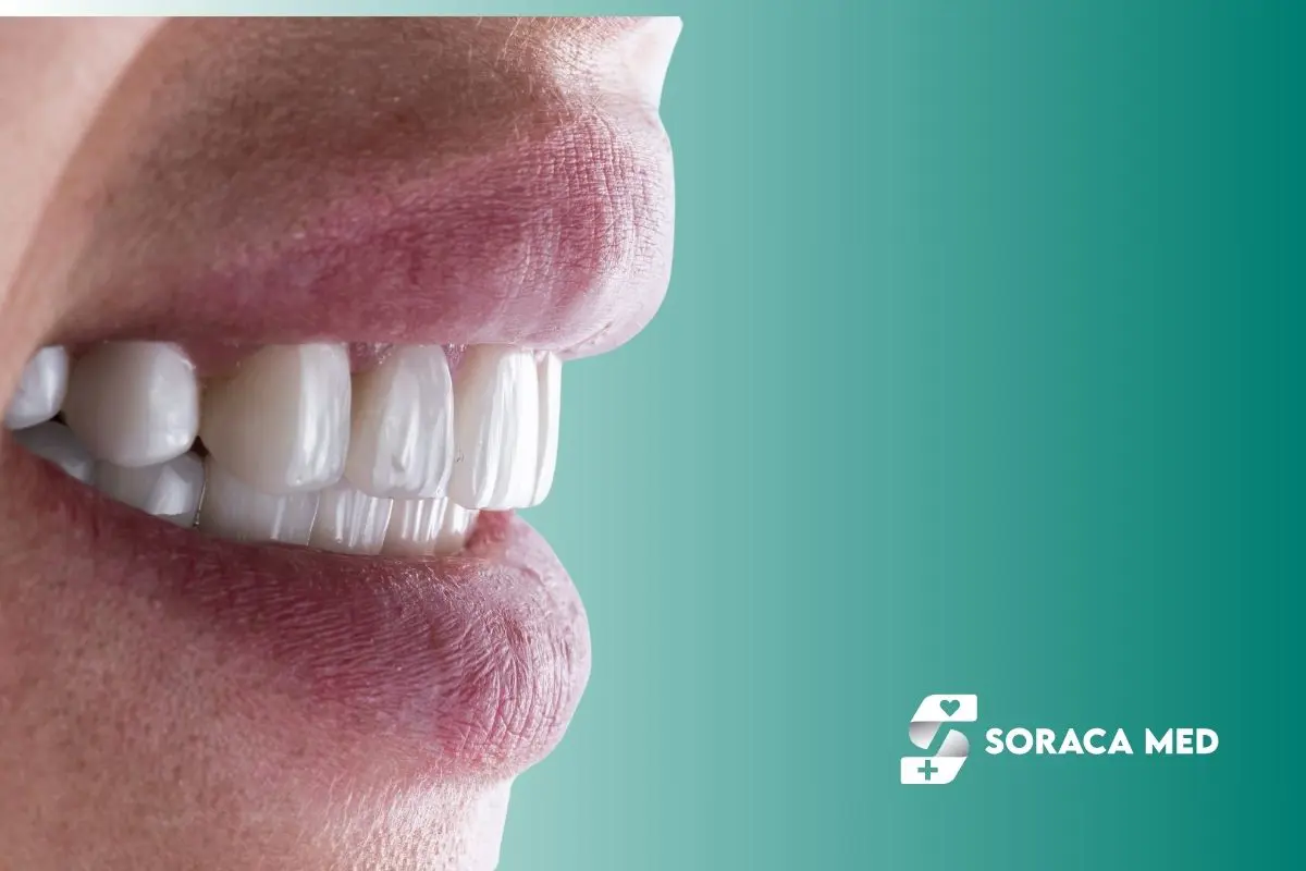 How To Avoid Fake-Looking Veneers