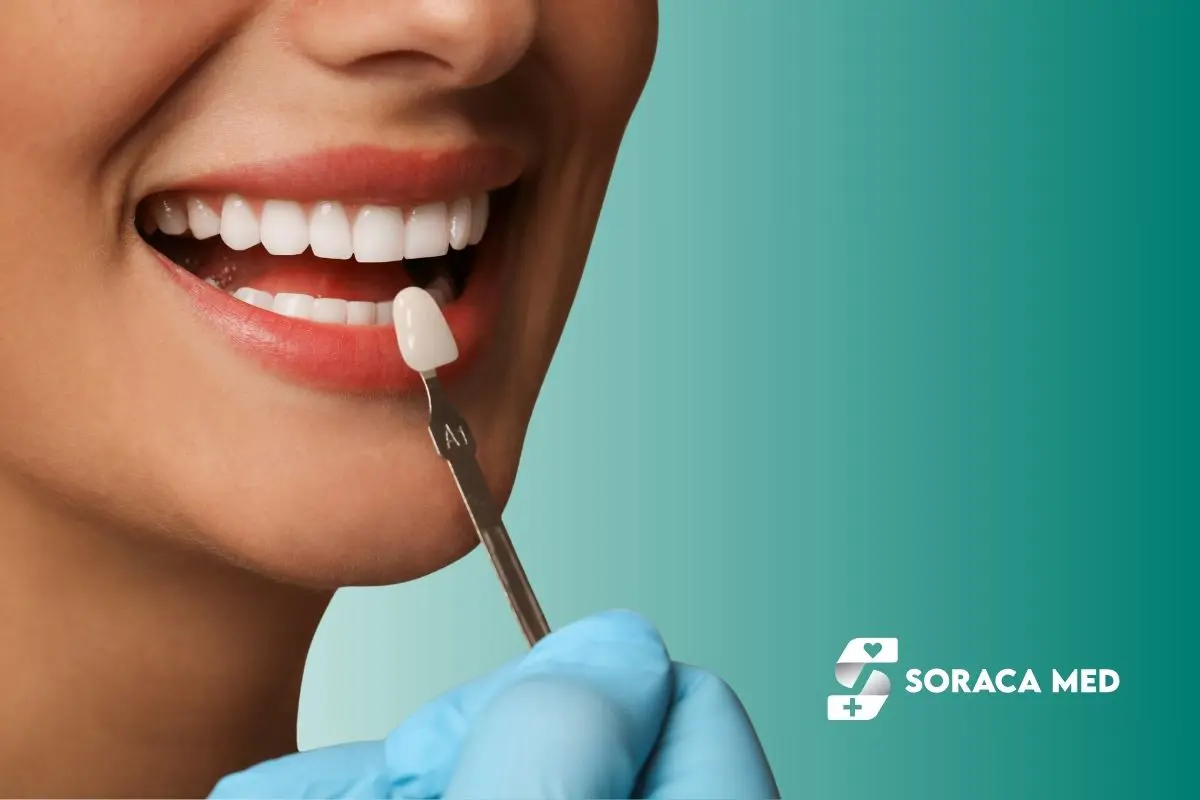Natural Looking Veneers