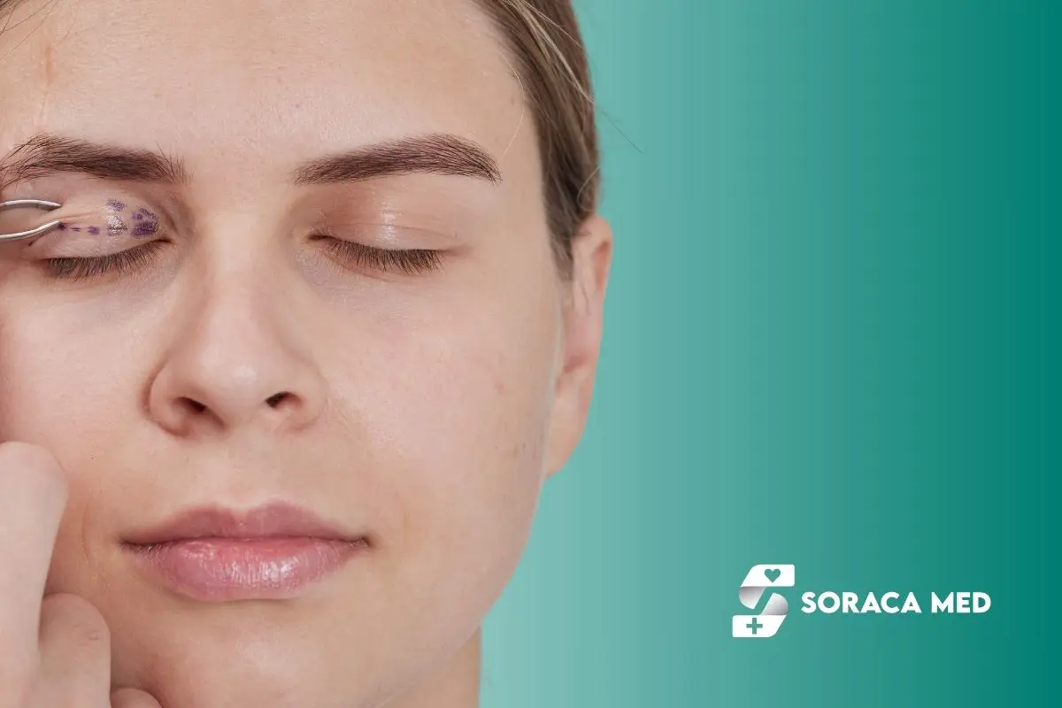 Upper Eyelid Surgery Cost