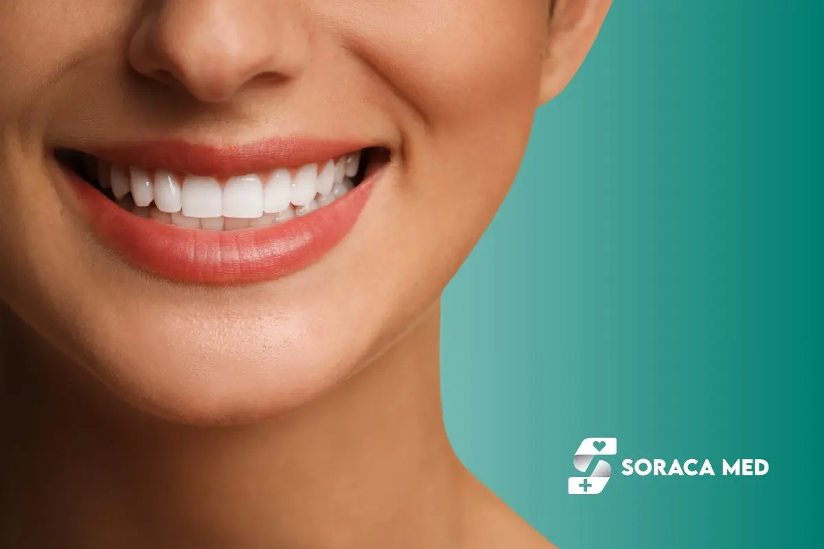 What Makes Veneers
