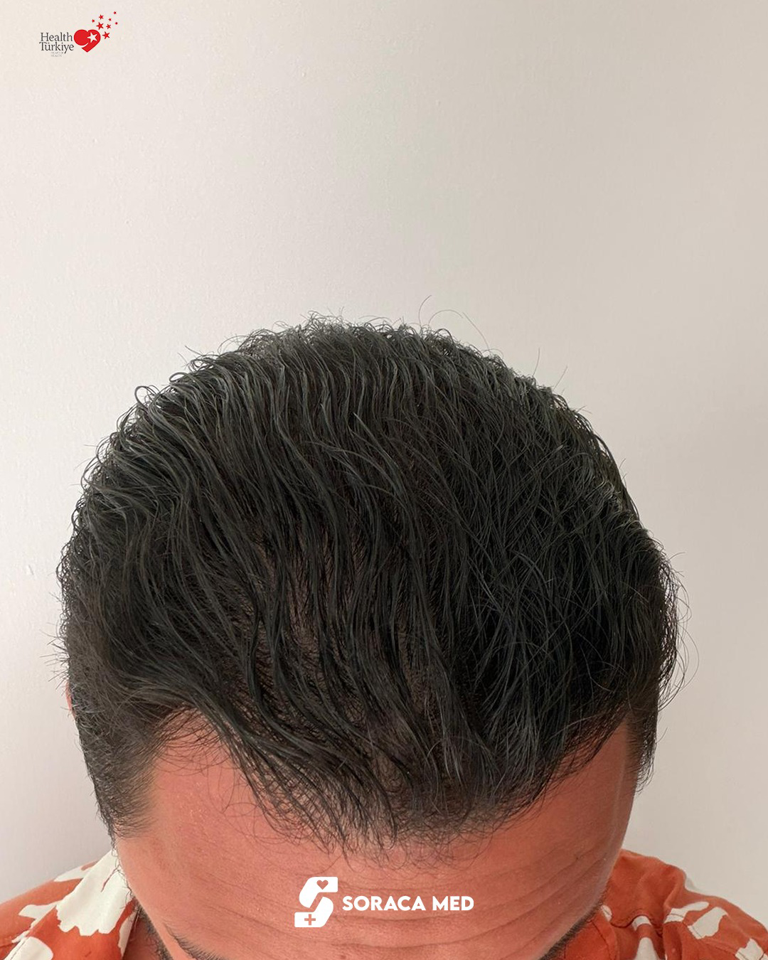 Soraca-Med-Hair-Patients (1)