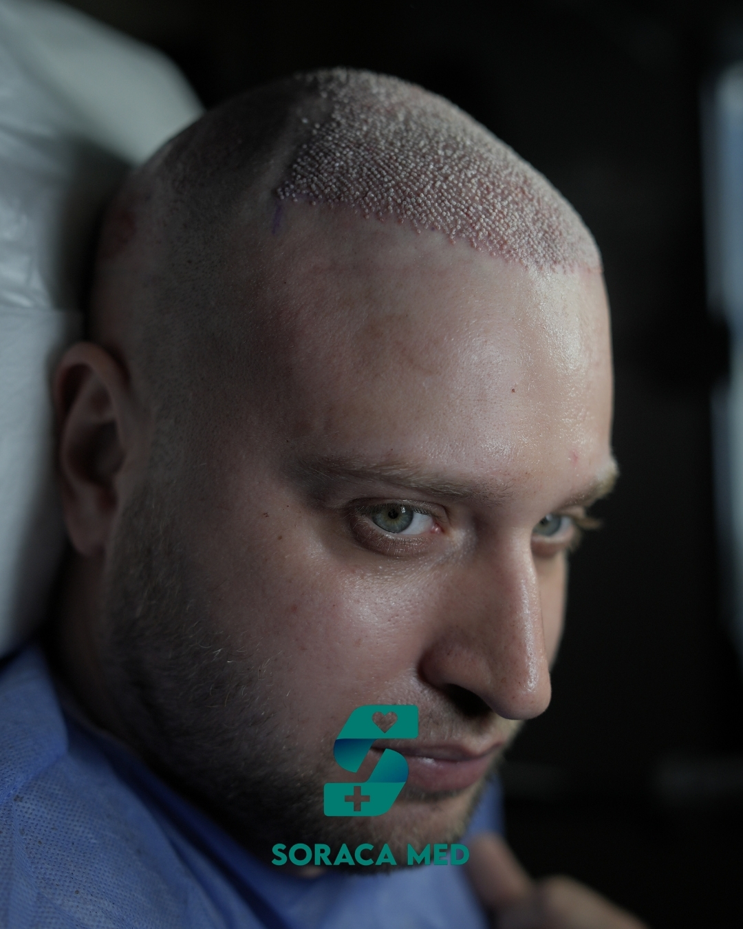 Soraca Med Hair Patients 2 (2)