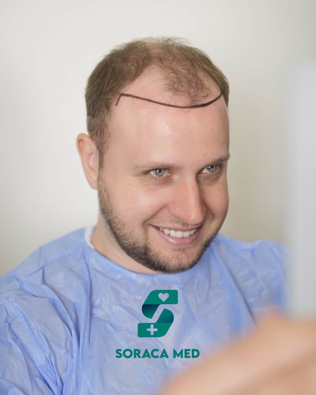 Soraca Med Hair Patients 2 (4)