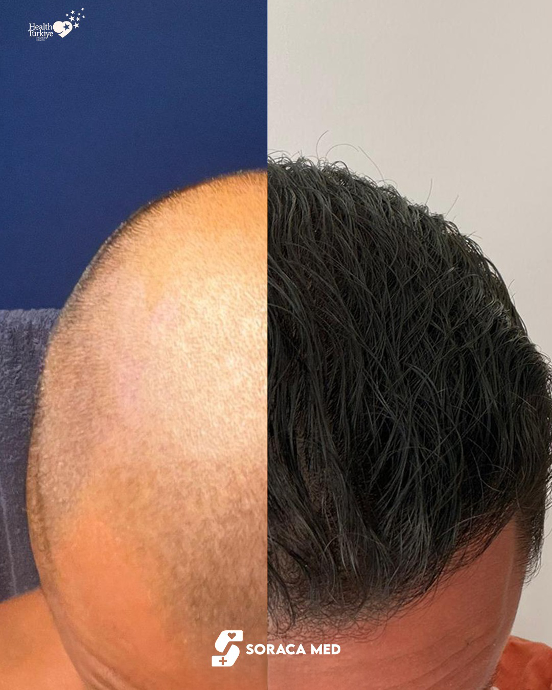 Soraca-Med-Hair-Patients (2)