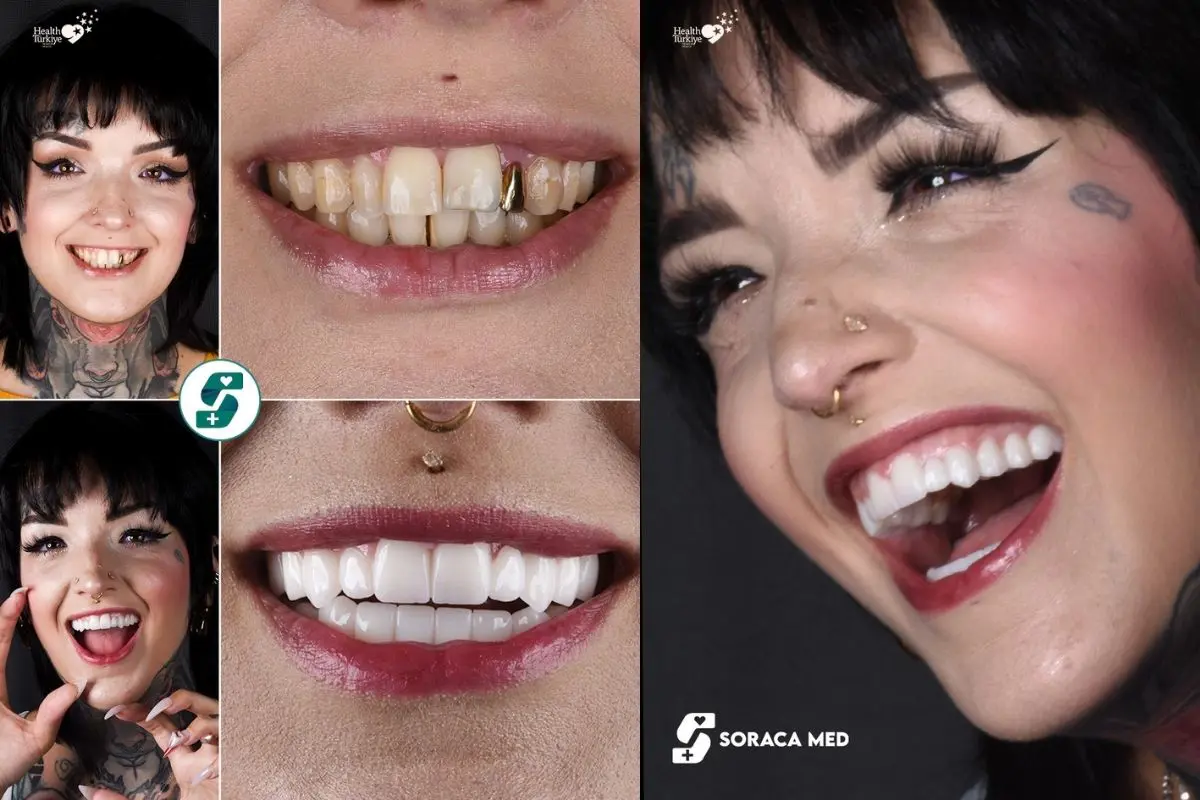 Zirconium Crowns Cost in Antalya: Price, Treatment & Results 1 Zirconium-Crowns-Cost-In-Antalya