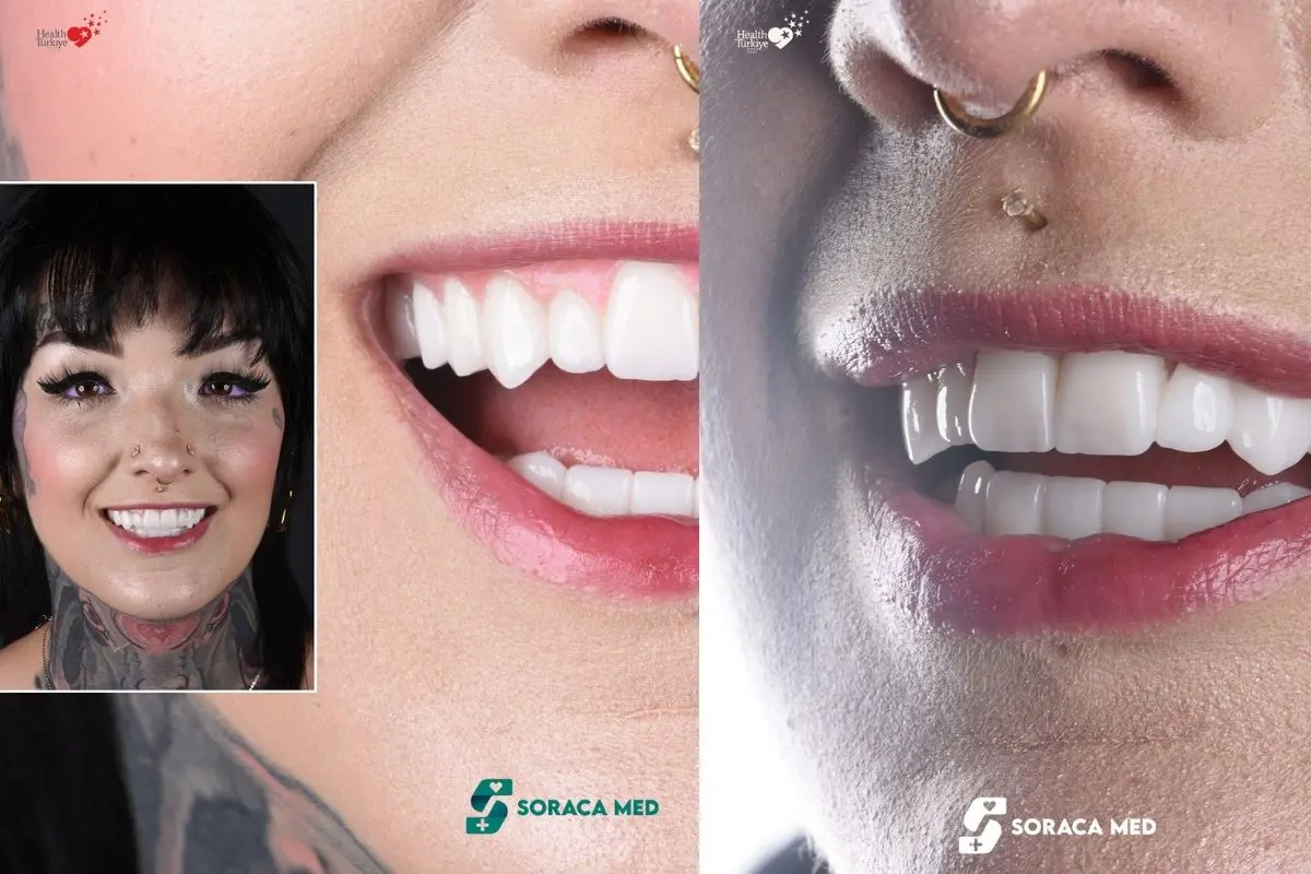 Zirconium Crowns Cost in Antalya: Price, Treatment & Results 2 Zirconium-Crowns-Cost