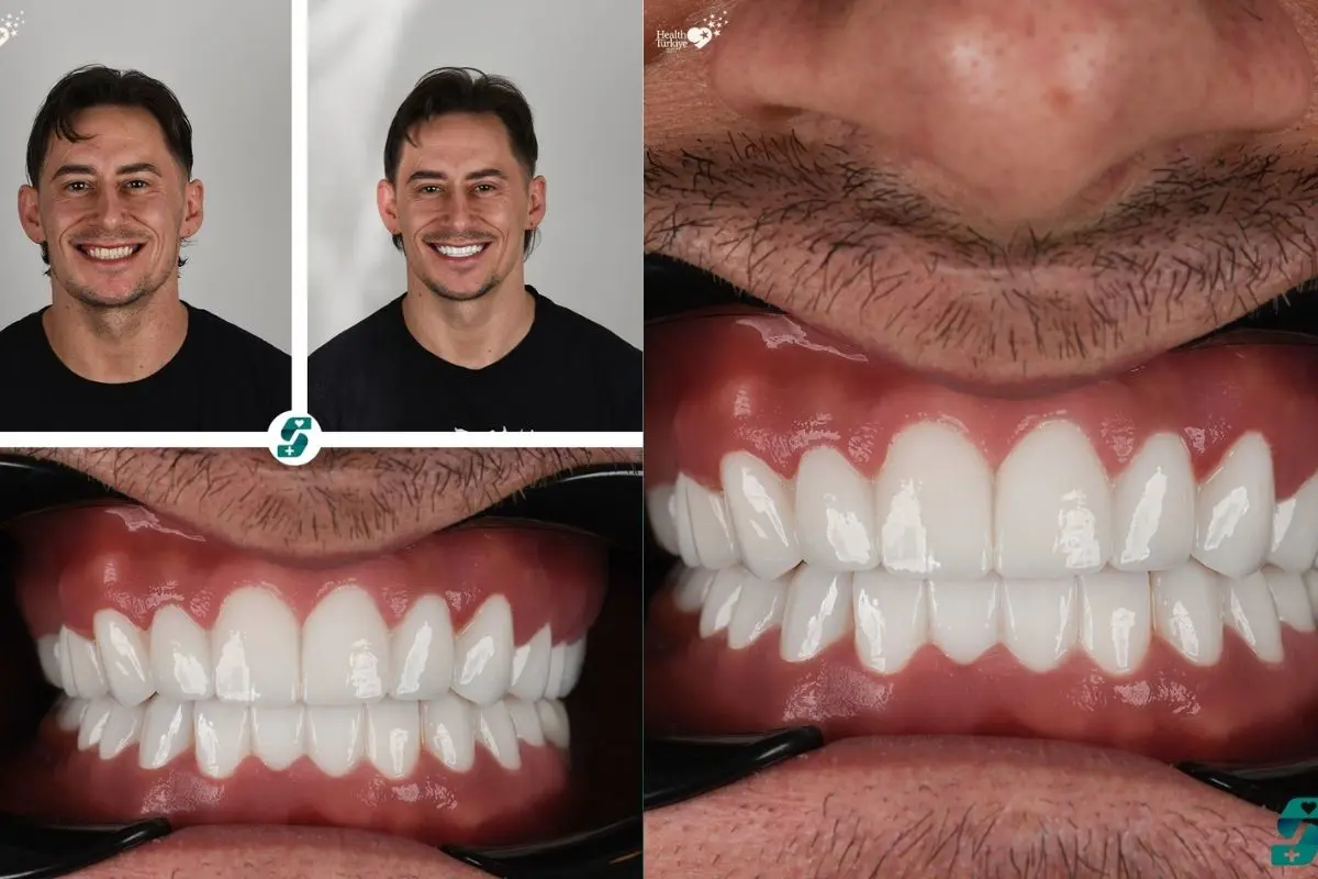E-Max Veneers Behandlung