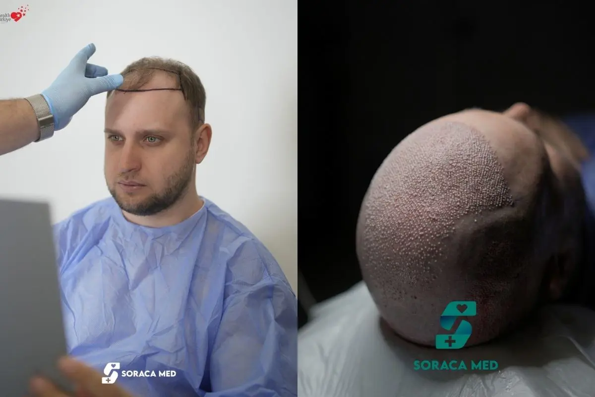 Haartransplantation Kosten Türkei: Preise, Methoden und Pakete bei Soraca Med 3 Haartransplantation Erfahrungen Türkei
