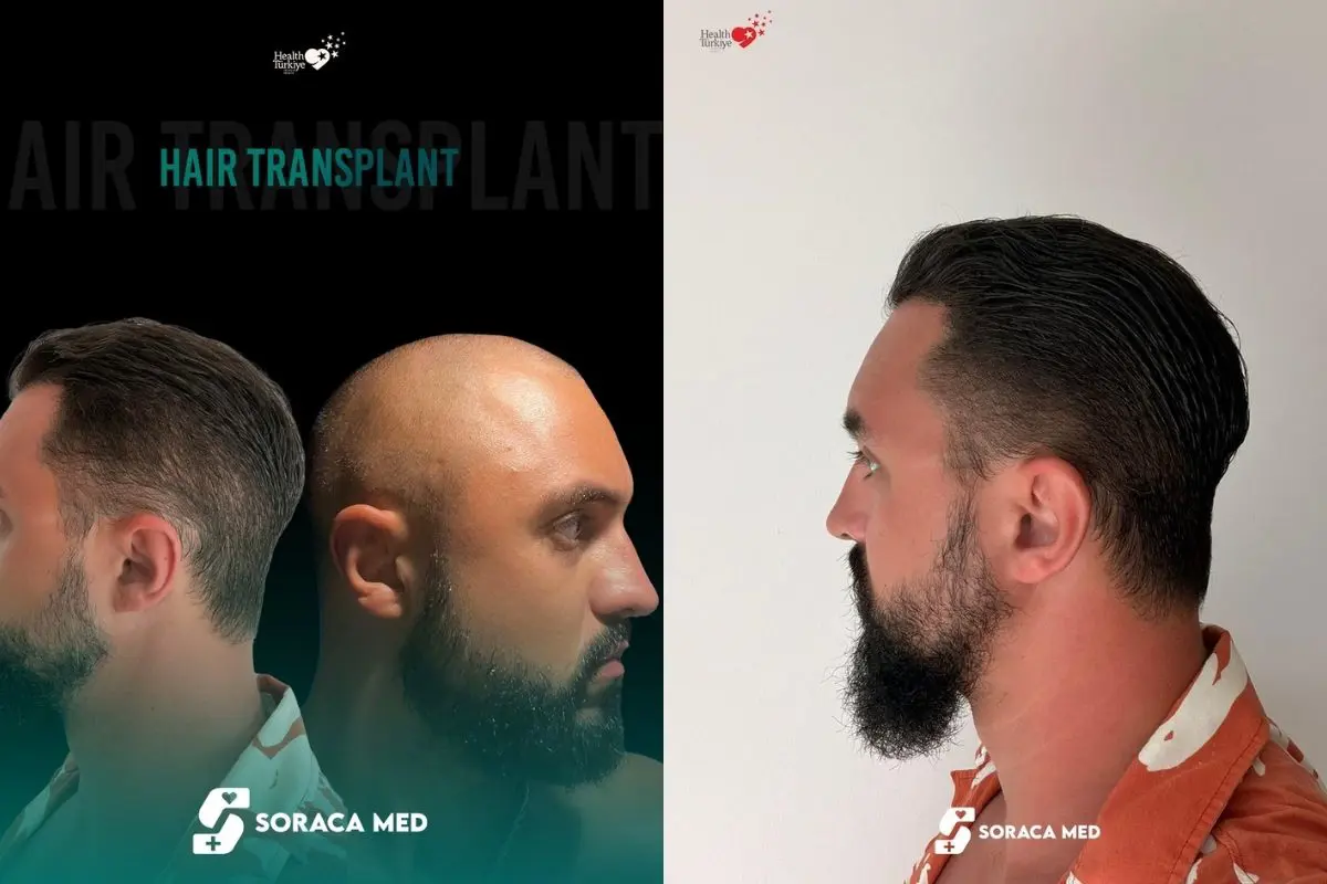 Haartransplantation Kosten Türkei