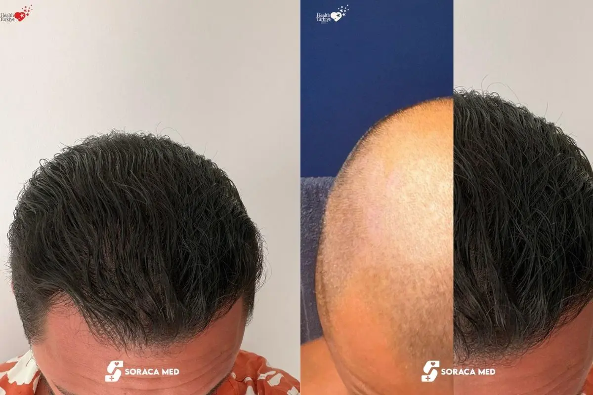 Hair Transplant Turkey Cost By Technique
