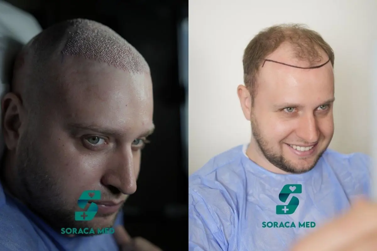 How To Choose The Right Turkey Hair Transplant Clinic
