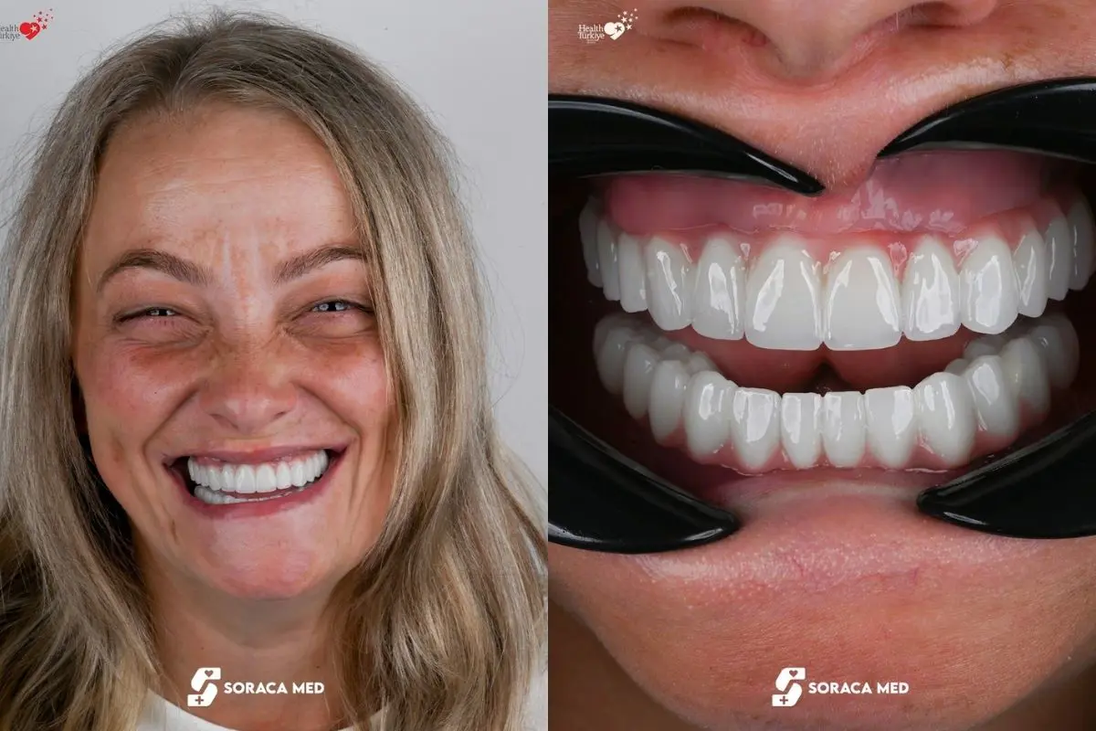 Mărci De Implanturi Dentare