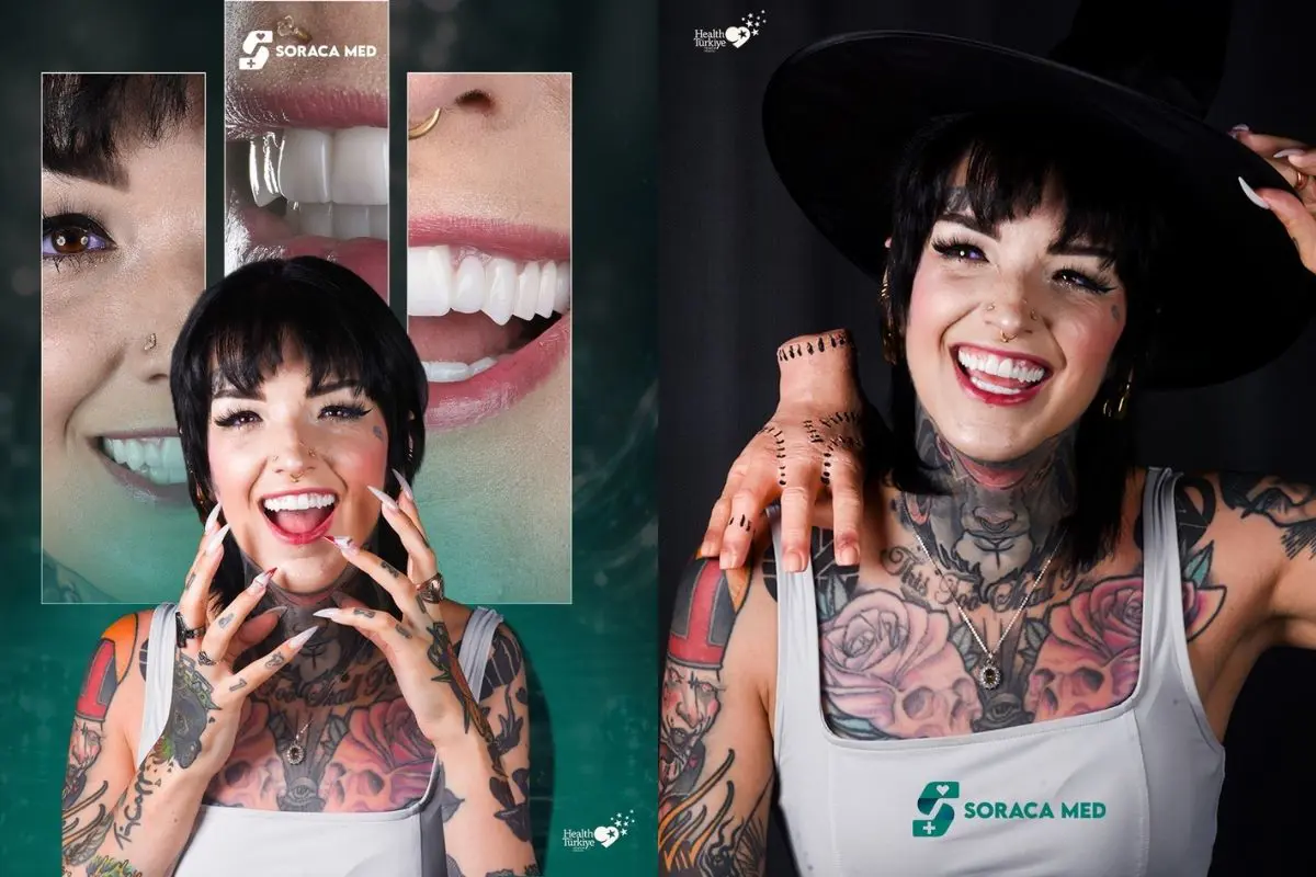 Veneers Kosten