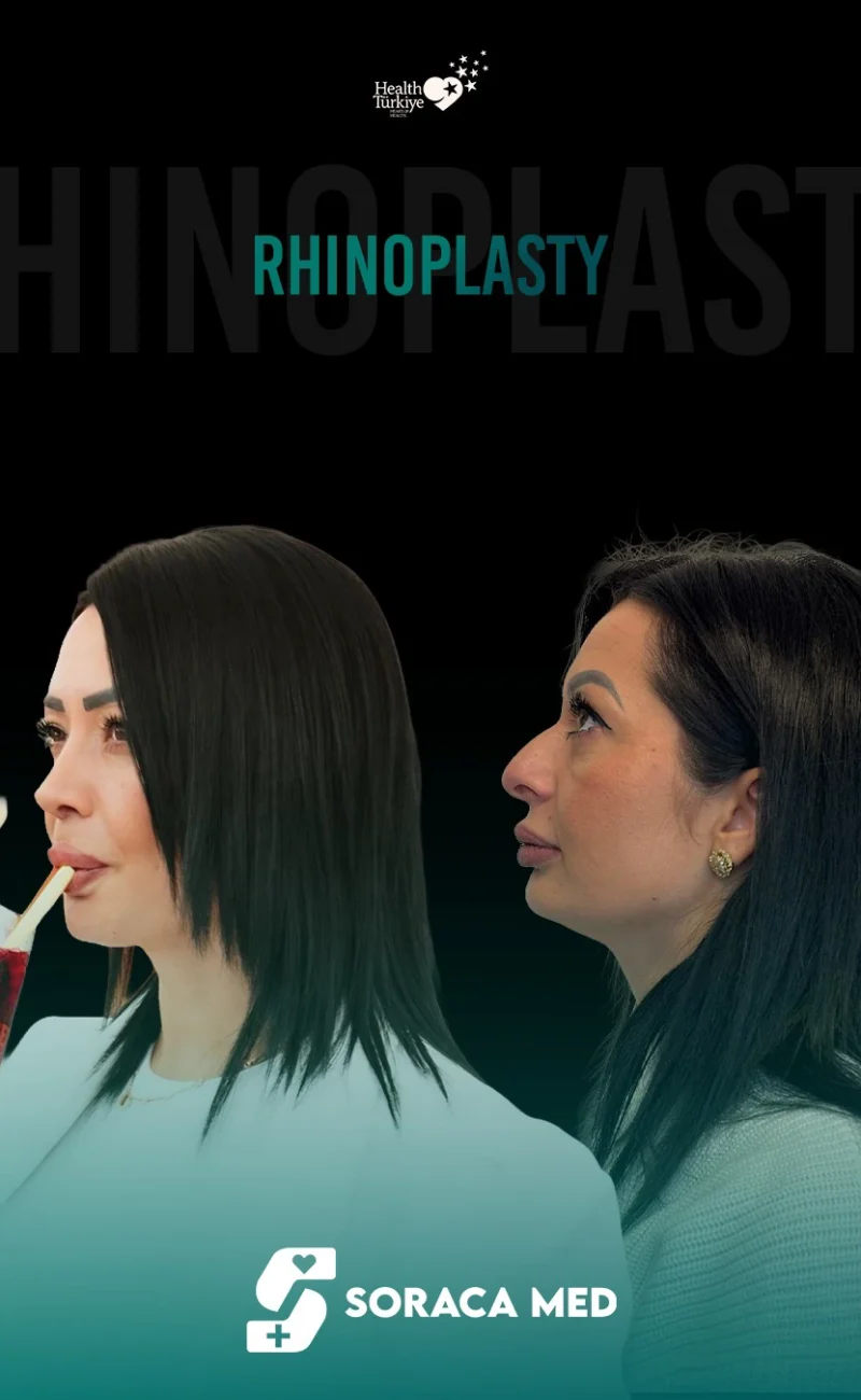 Rhinoplasty Before After
