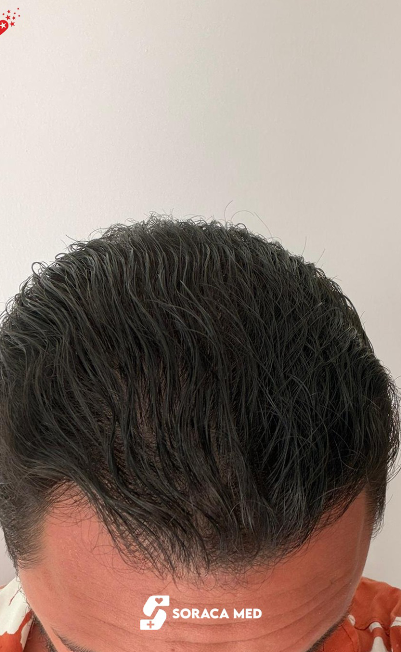 Soraca-Med-Hair-Patients (1)
